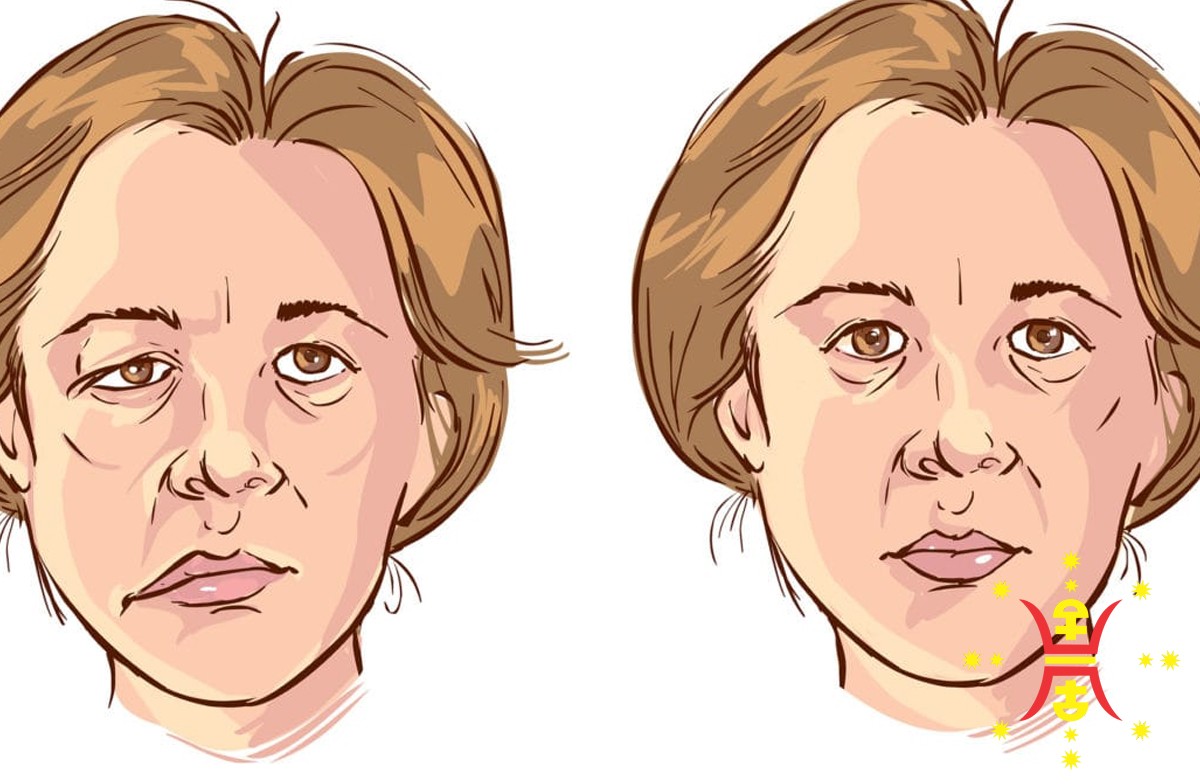 Bells-Palsy Natural Remedy